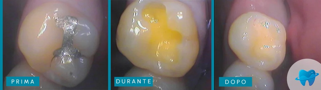 Risultato prima e dopo Dental Marina
