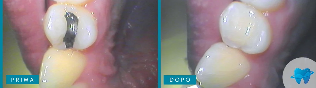 Caso reale prima e dopo Dental Marina