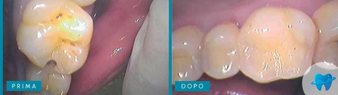 Percorso di cura prima e dopo Dental Marina