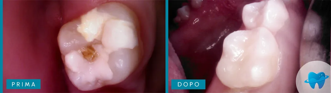 Caso clinico prima e dopo presso Dental Marina
