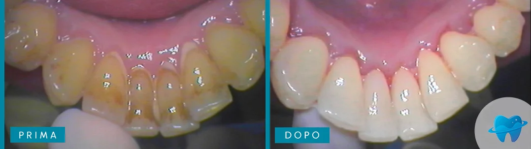 Immagine prima e dopo trattamento Dental Marina