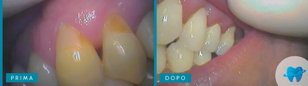 Prima e dopo caso reale Dental Marina