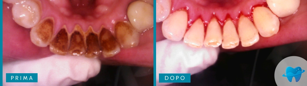 Risultato odontoiatrico prima e dopo Dental Marina