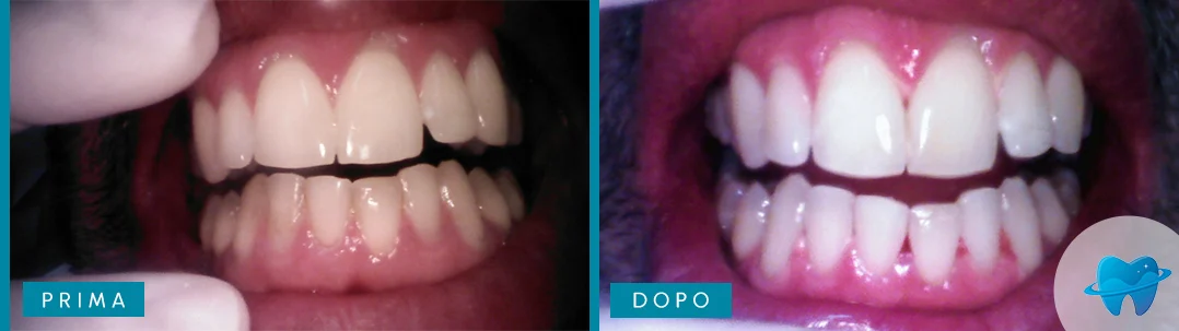 Caso di sbiancamento Dental Marina prima e dopo